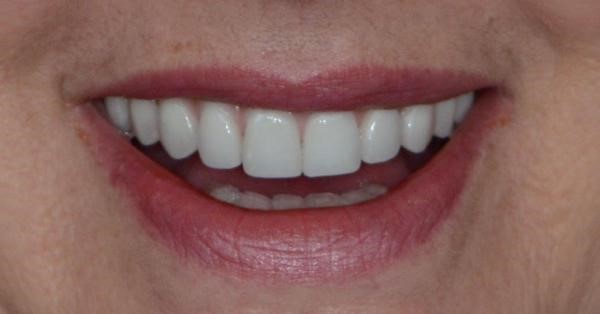 Permanent Dentures Forked River NJ 8731